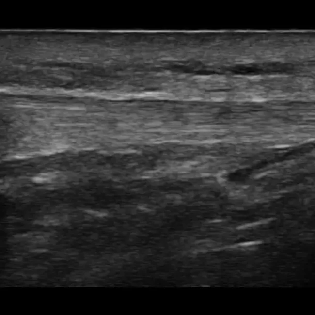 Patellar-Tendon-Insert